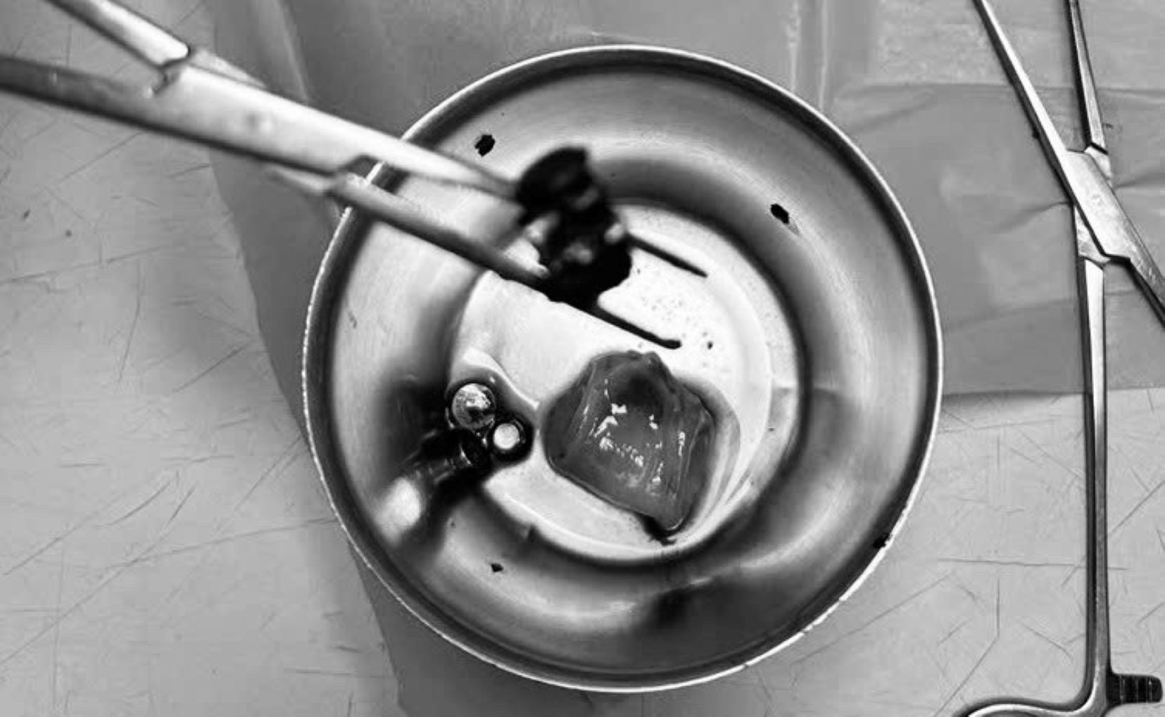 The foreign objects were surgically removed from the baby's belly by doctors at Soc Trang Obstetrics and Pediatrics. Photo: Provided by the unit