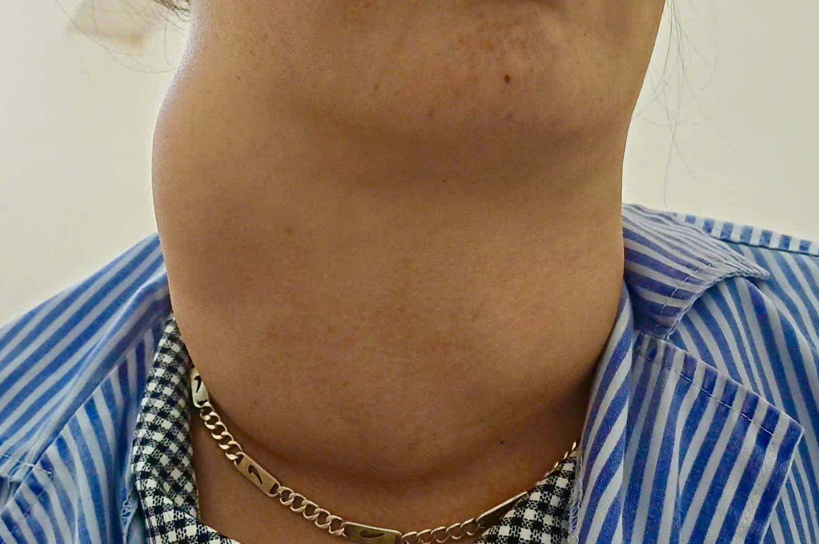 A 41-year-old female patient with a giant thyroid disease was treated. Photo: BVCC