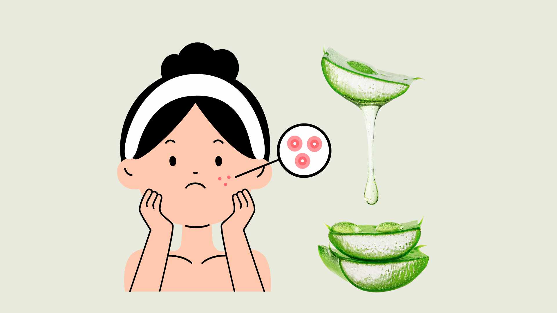 Gel from aloe vera leaves contains natural salicylic acid and sulfur, which are effective in treating acne. Graphic photo: Hoang Loc