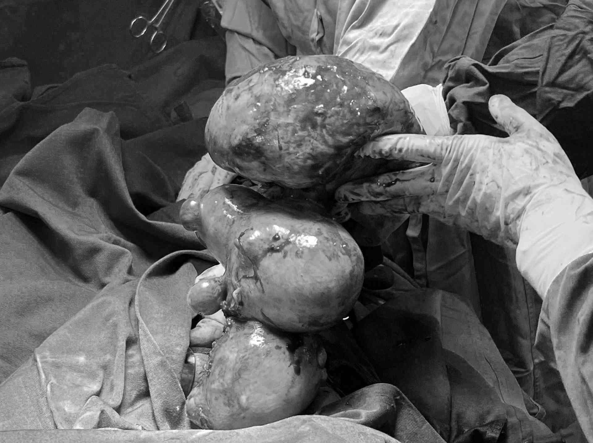 Successfully operated on a giant uterine fibroid tumor of nearly 10kg for the patient. Photo: BVCC