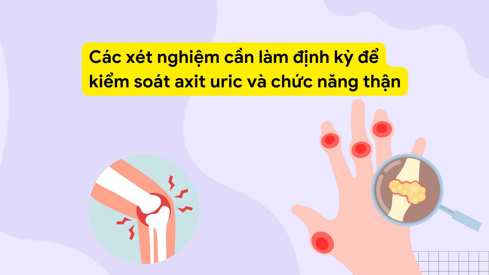 Testing for uric acid in the blood is the most basic step to assess the risk of gout and purine metabolism disorder. Graphic photo: Huong Son