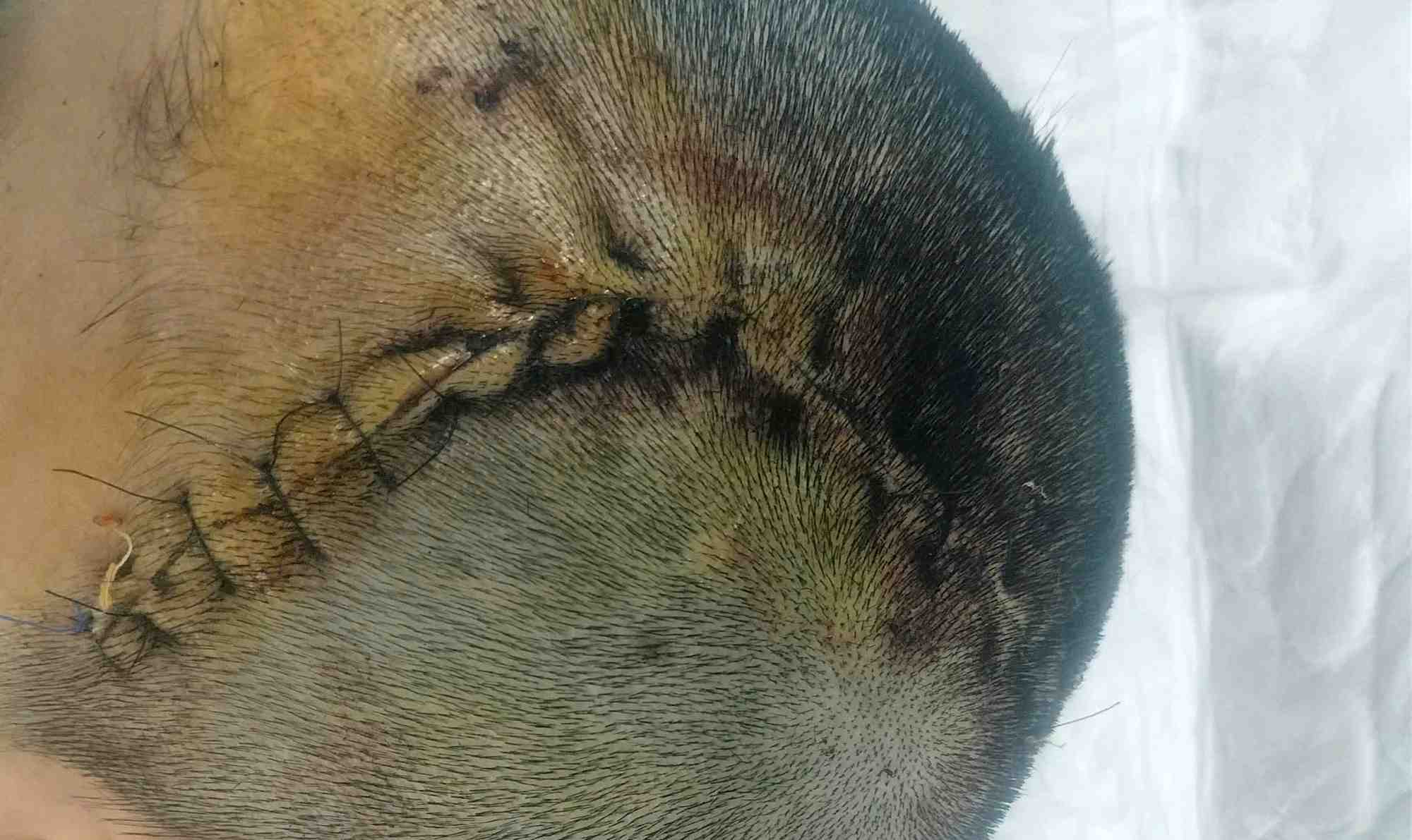 Em Nguyen Huu Bao Duy sau khi duoc bac si Benh vien Huu nghi da khoa Nghe An phau thuat. Anh: Nguoi nha cung cap