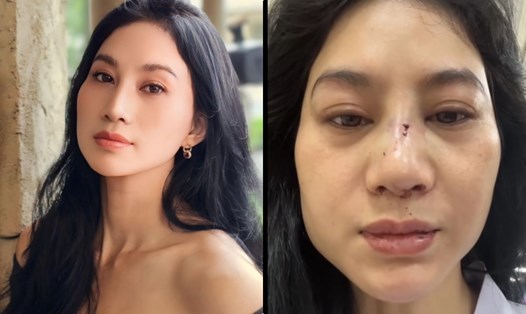 Diễn viên Phi Ngọc Ánh cho biết bị chồng cũ bạo hành. Ảnh: Nhân vật cung cấp.