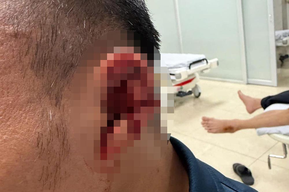 Trong Hoang's injury caused him to have to take many stitches. Photo: Vlog Minh Hai