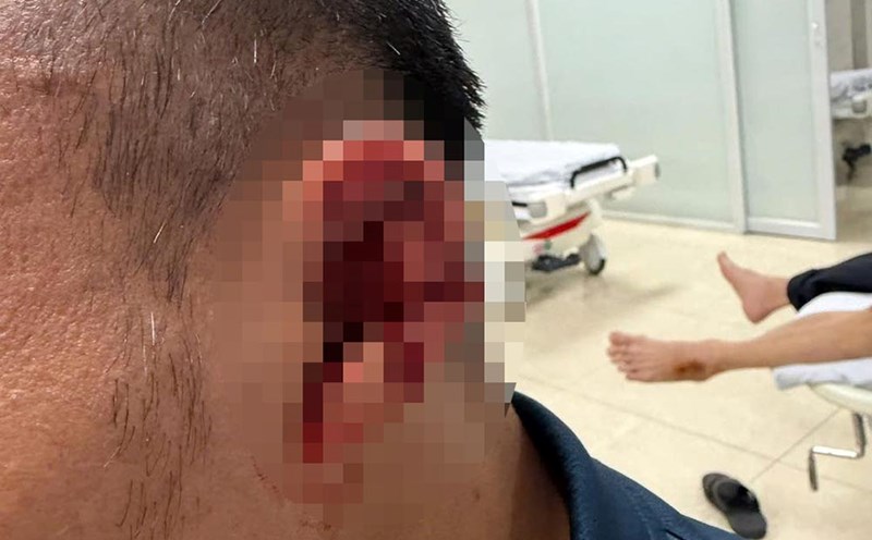 Trong Hoang's injury caused him to have to take many stitches. Photo: Vlog Minh Hai