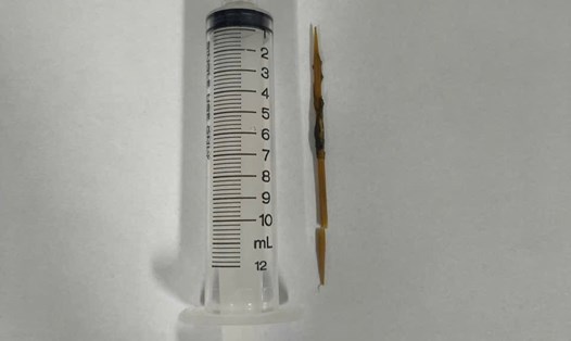 Chiếc tăm tre được các bác sĩ Bệnh viện Đa khoa Khánh Hòa gắp ra từ đại tràng nam bệnh nhân. Ảnh: Bệnh viện Đa khoa Khánh Hòa