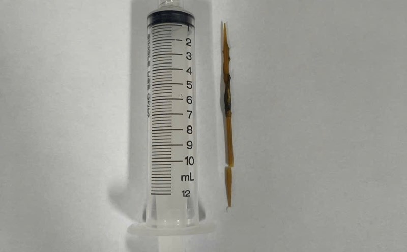 The bamboo toothpick was removed by doctors at Khanh Hoa General Hospital from the patient's male colon. Photo: Khanh Hoa General Hospital