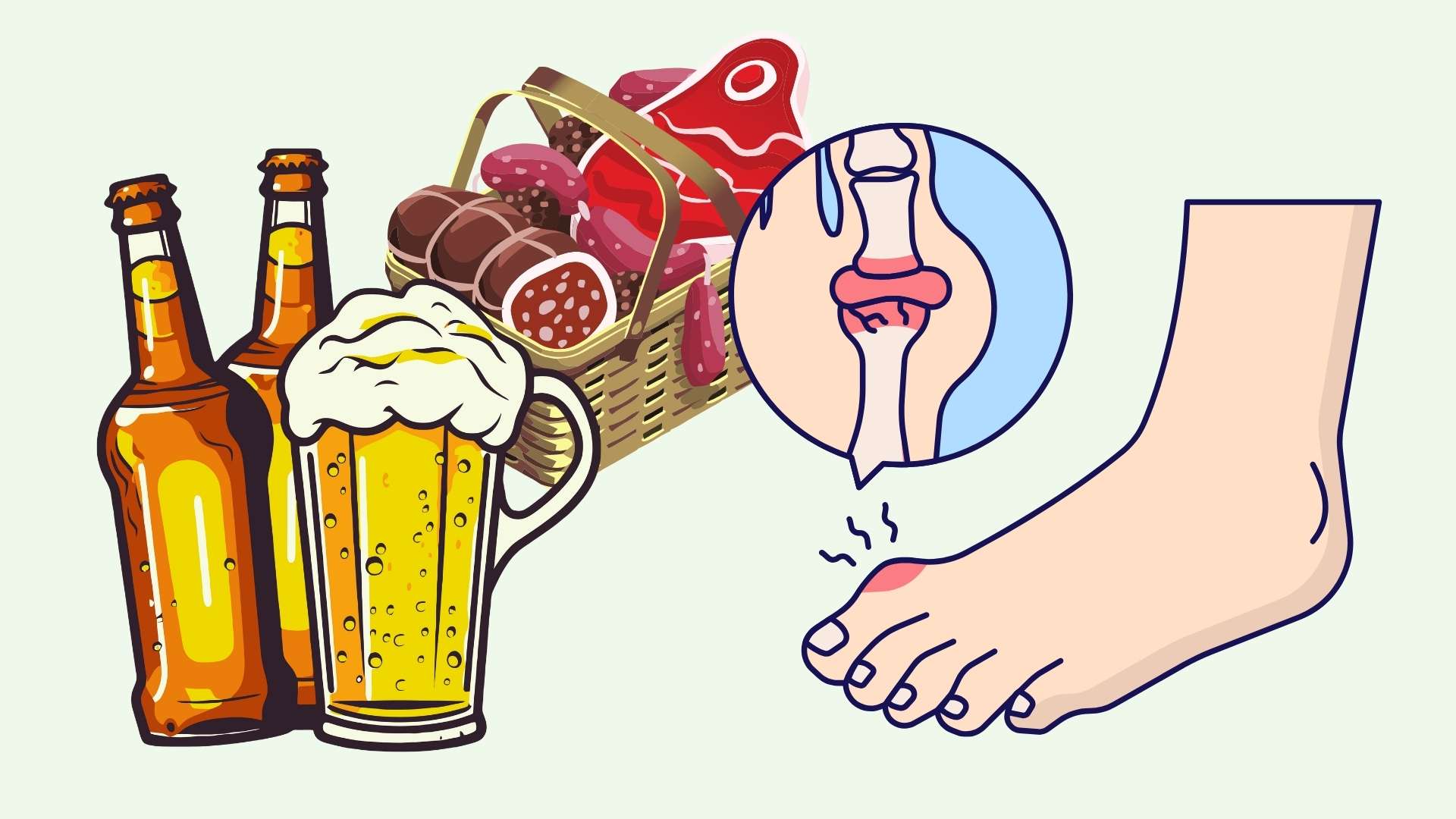 High uric acid silently forms kidney stones. Graphics: Linh Dan