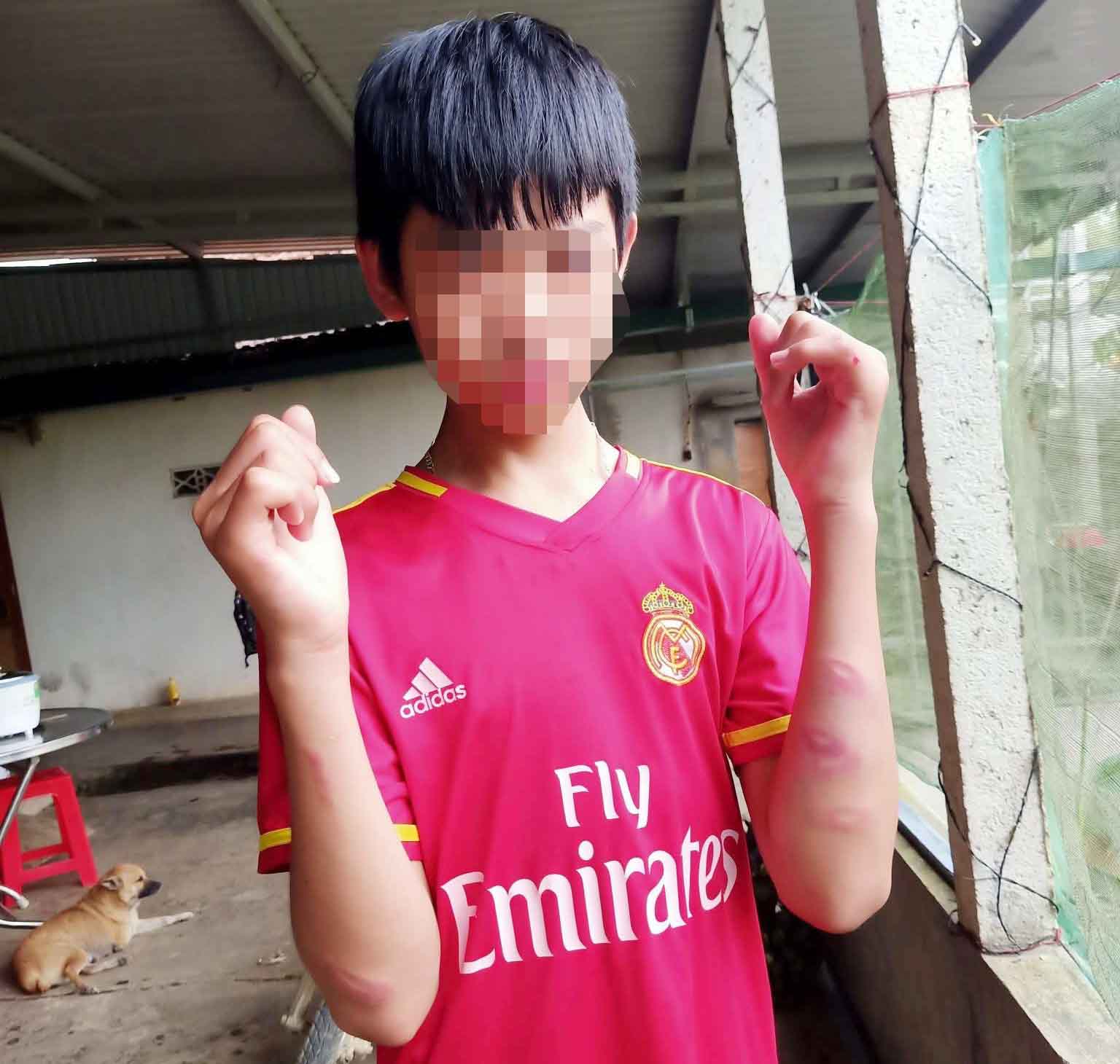 2 tay cua Manh bi danh sung, bam tim. Anh: Tran Tuan.
