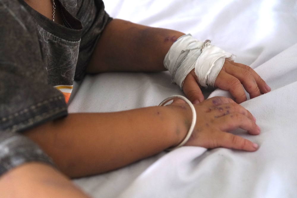 Hand, foot and mouth disease broke out in Can Tho, blisters were noticeable in young children