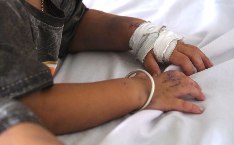 Hand, foot and mouth disease broke out in Can Tho, blisters were noticeable in young children