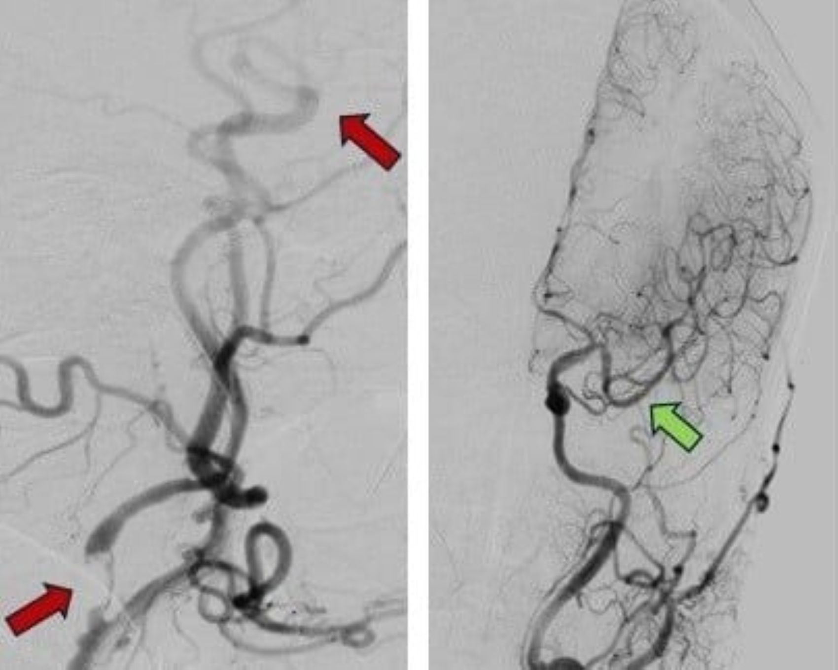 혈관 막힘으로 인한 뇌졸중(빨간색 화살표) 및 완전한 재개통 후(녹색 화살표) 이미지. 사진: 병원 제공