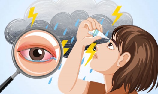 Giải pháp đơn giản cho chứng khô mắt trong mùa mưa ẩm ướt. Đồ họa: Thiện Nhân
