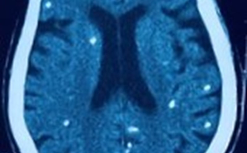 Many optic obstructions in the patient's brain's mole suspected of streptococcus. Photo: BVCC