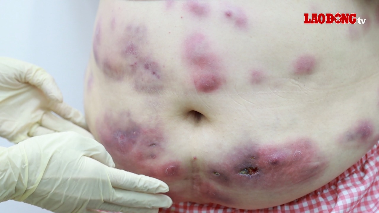 The patient suffered from fat smoking complications. Photo: BVCC