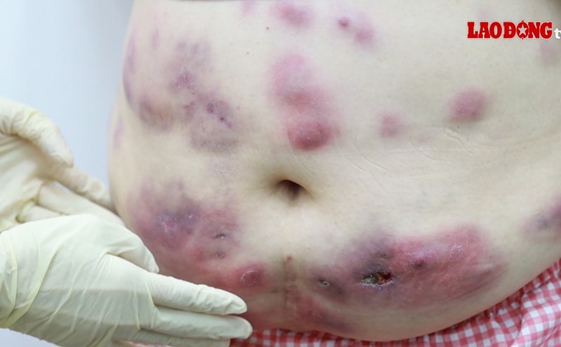 The patient suffered from fat smoking complications. Photo: BVCC