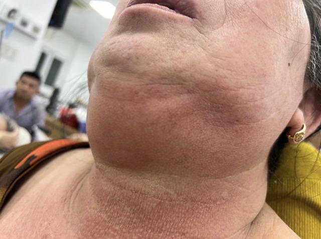 The diabetic patient had swelling spreading to his chin, and had difficulty breathing, so he was hospitalized. Photo: BVCC