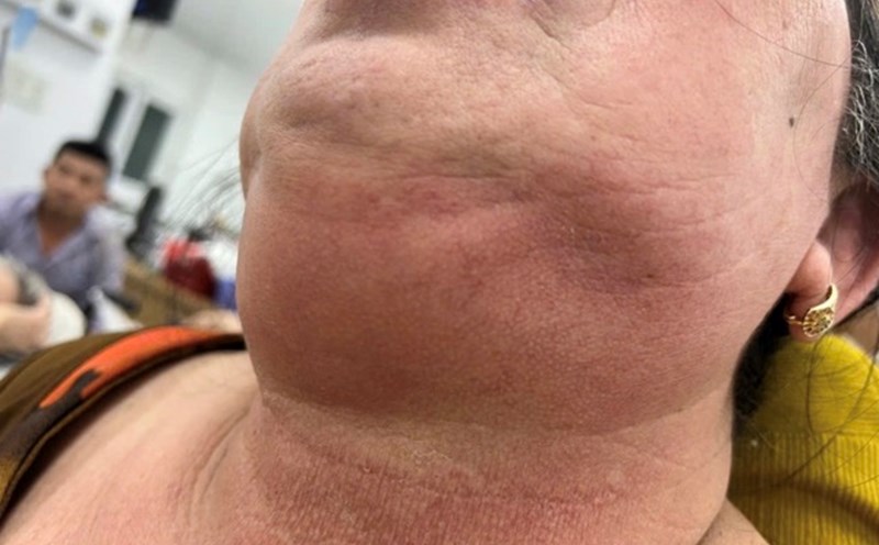 The diabetic patient had swelling spreading to his chin, and had difficulty breathing, so he was hospitalized. Photo: BVCC