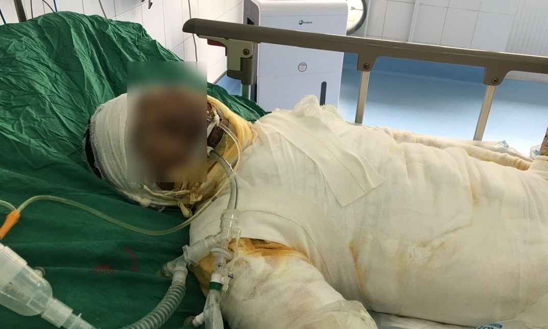 Em Nguyen Van Tuyen nam dieu tri tai Khoa Cap cuu - Benh vien Bong Quoc gia Le Huu Trac sau tai nan dien giat. Anh: Nguoi nha cung cap