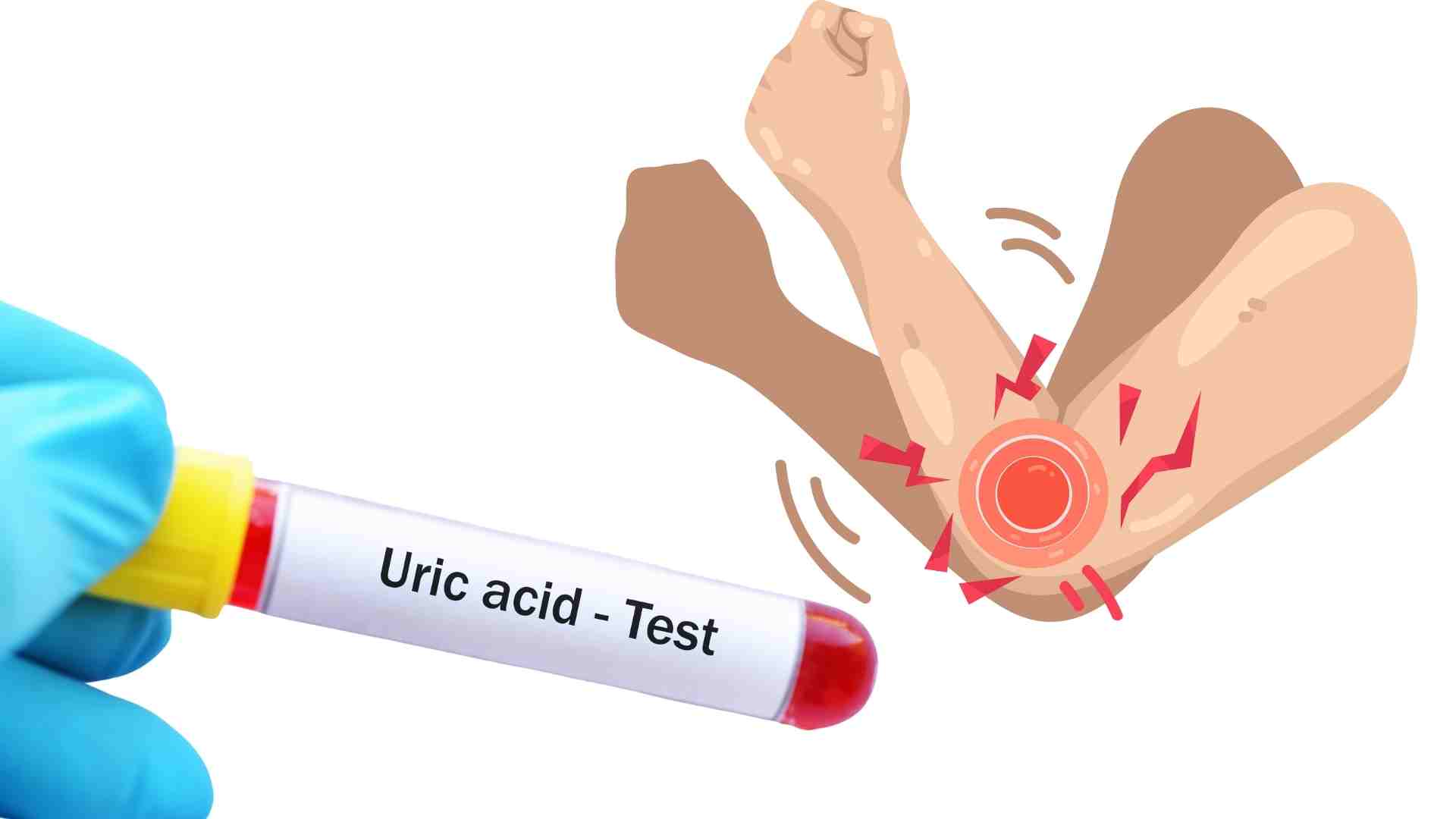 Many small changes in the upper body signal high uric acid. Graphics: Ha May
