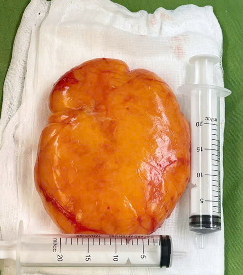 The giant fat tumor was successfully removed. Photo: BVCC
