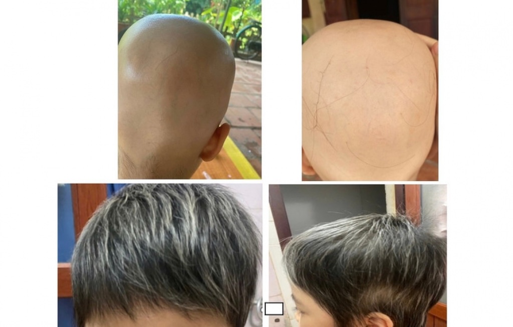 Images of young patients with hair loss being treated at the Central Dermatology Hospital. Photo: BVCC