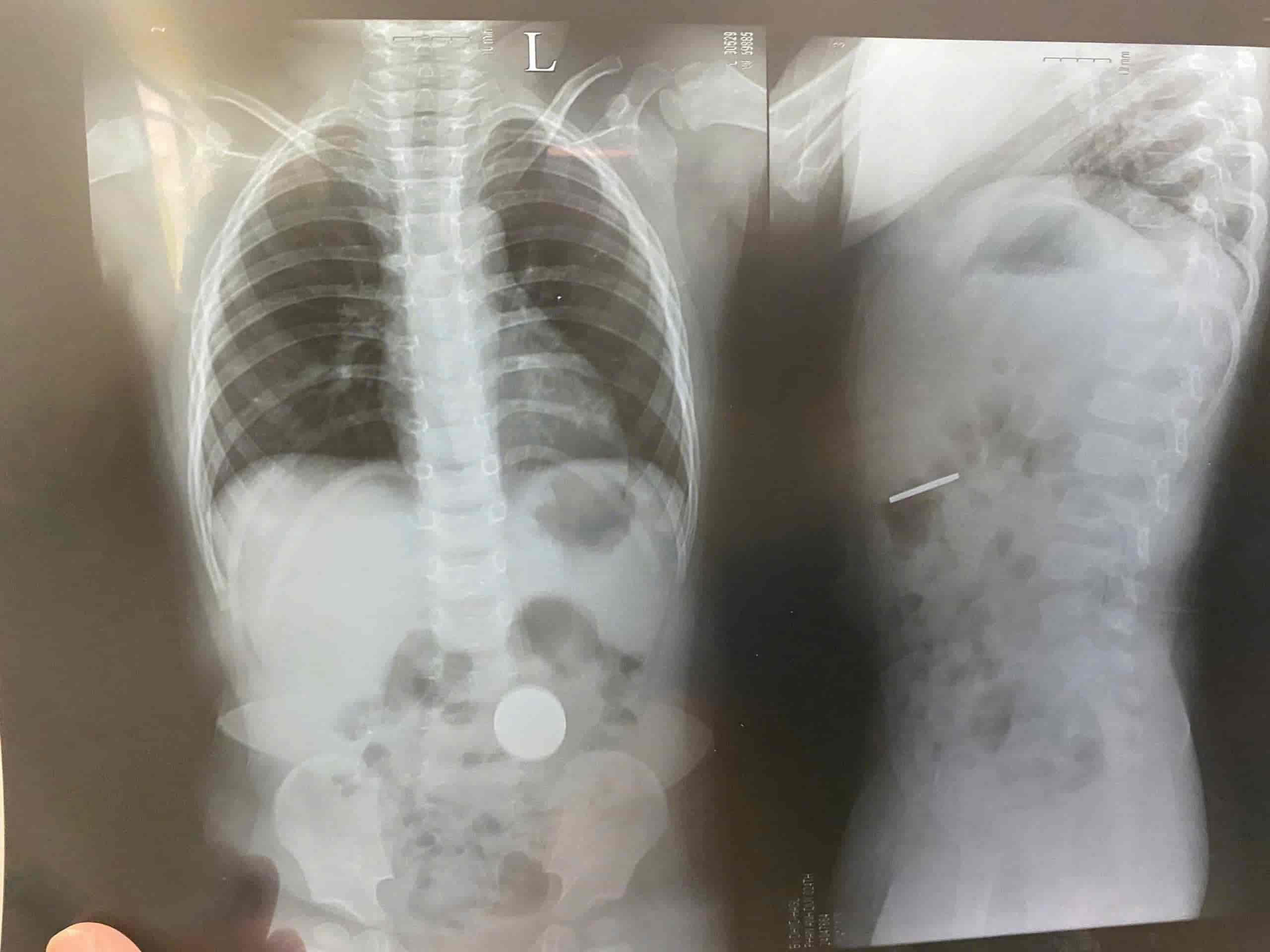 X-quang da day chau be phat hien co di vat. Anh: Moc Mien