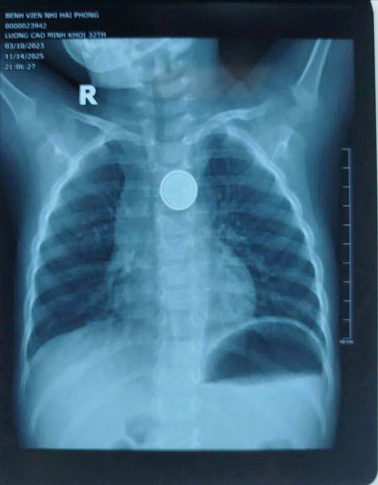 Image of a chamomile battery from a toy stuck in the esophagus of a 32-month-old boy in Hai Phong. Photo: Hai Phong Children's Hospital