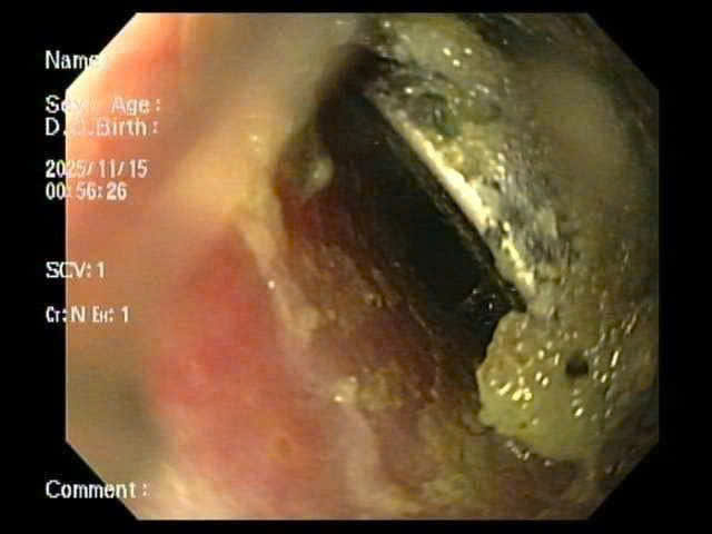 Hinh anh vien pin cuc trong thuc quan benh nhi. Anh: Benh vien Nhi Hai Phong