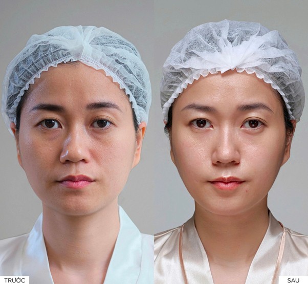 Dien vien Lam Vy Da thay doi sau lieu trinh: da am min, cau truc san chac, than sac rang ro – danh gia cao su minh bach. Anh: Tham my Linh Anh Premium