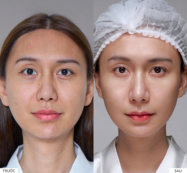 Phac do ca nhan hoa cho Lynk Lee: dung van de, dung tang dich. Anh: Tham my Linh Anh Premium