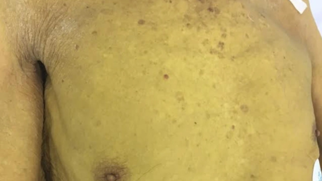 In the early stages, hepatitis B often has no obvious signs. Photo: Nguyen Ly