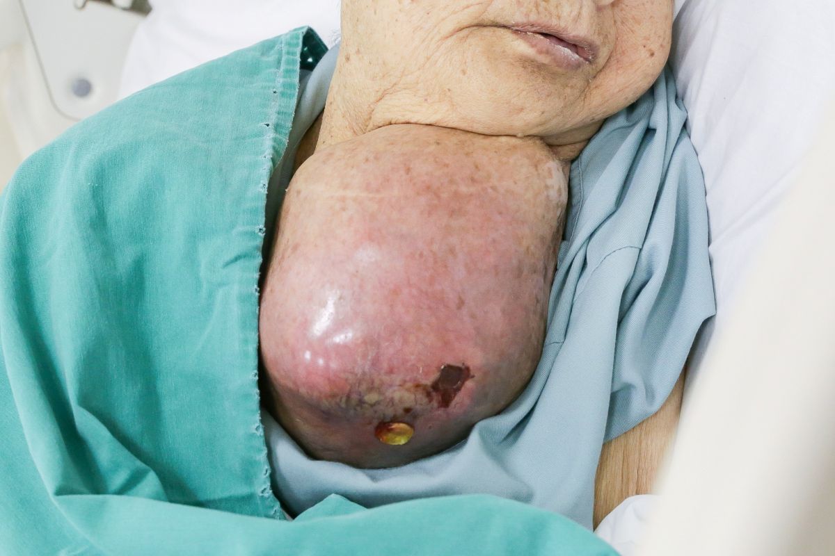 Khoi u khong lo chen ep vung co benh nhan. Anh: Vinmec