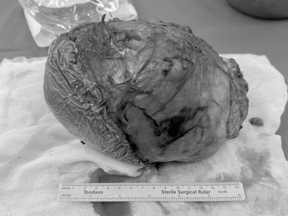 Khoi u nang khoang 1,7kg. Anh: Vinmec