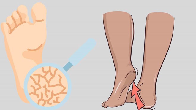 건조한 날씨는 발뒤꿈치가 쉽게 갈라지고 피가 나고 통증을 유발합니다. 그래픽: 호앙록