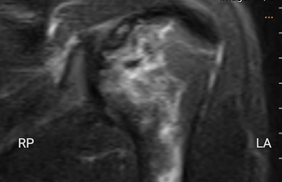 X線で撮影された左腕の肋骨の壊死画像。写真:Quang Binh友好病院