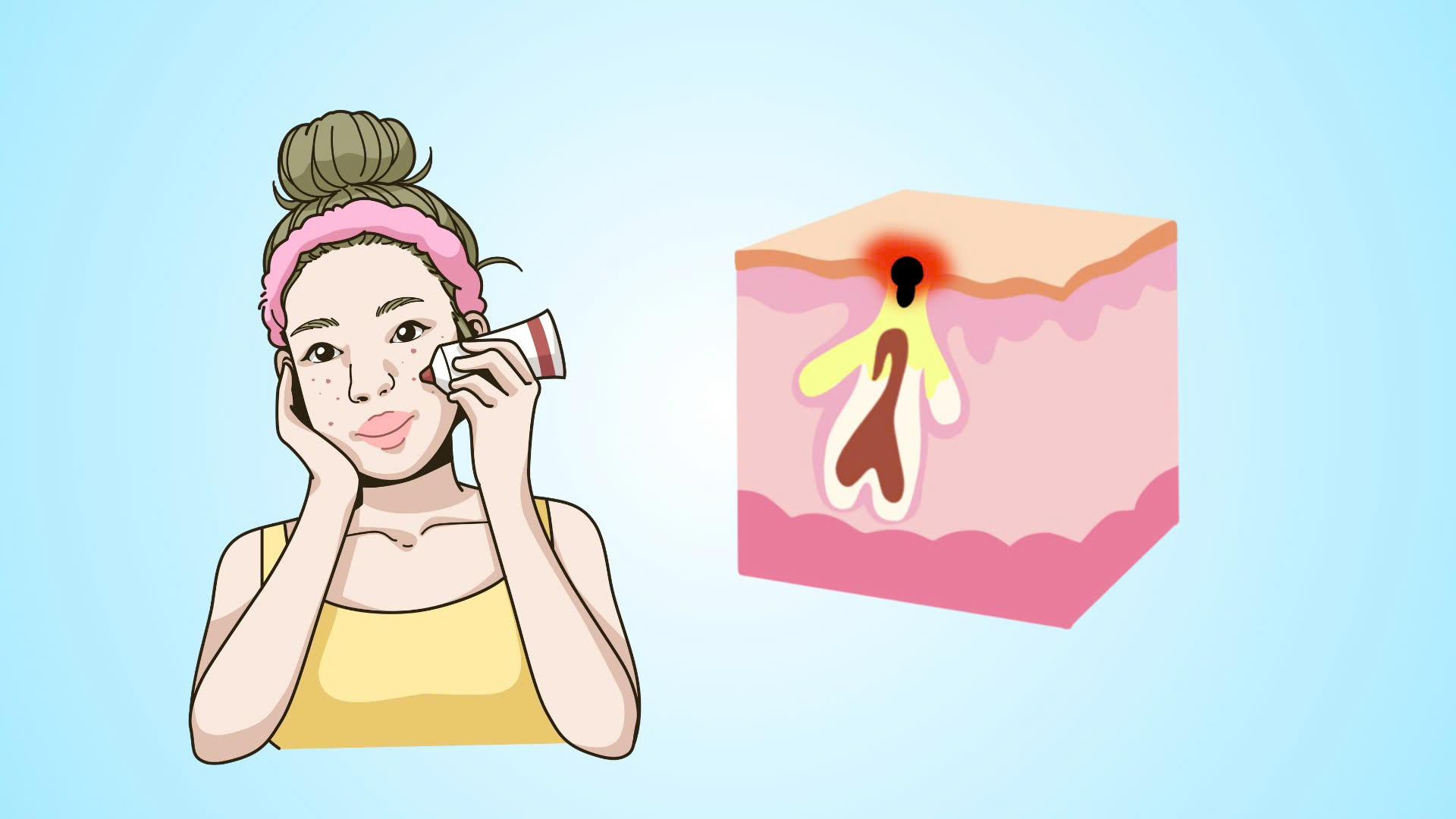 5 tips to remove blackheads on the skin.