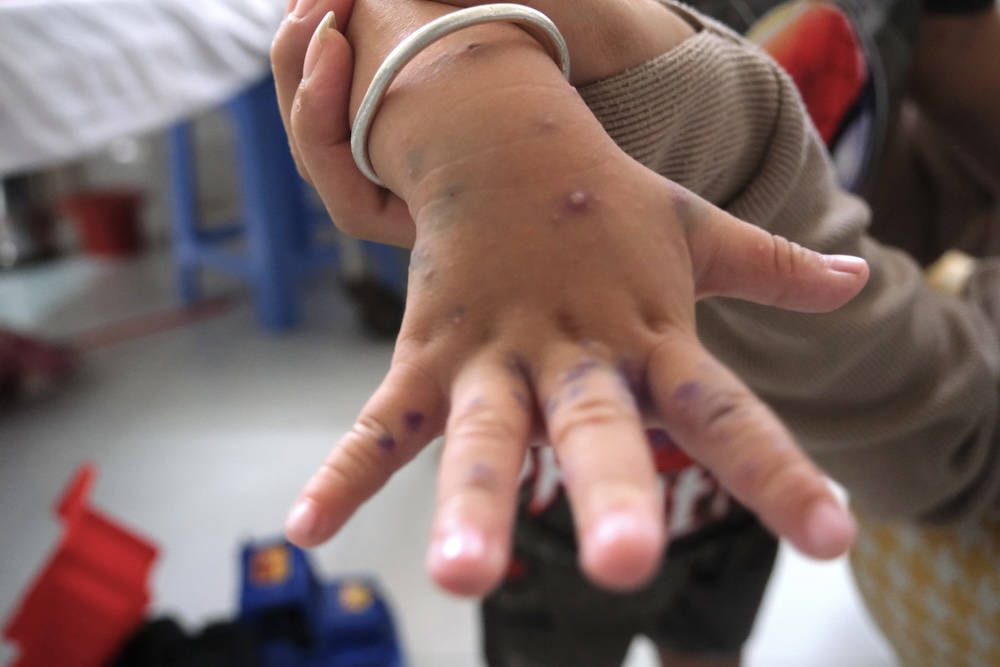 Benh tay chan mieng tai DBSCL dang dien bien phuc tap, bac si canh bao tre hoan toan co the bi nhieu lan. Anh: Phong Linh.