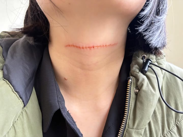 Người phụ nữ bị dây diều mắc vào cổ tạo vết xước dài. Ảnh: Công an xã An Thành, Hải Phòng