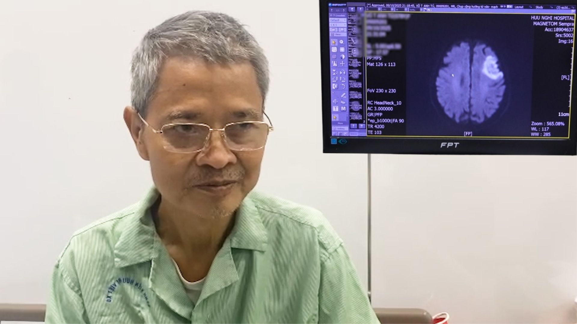 Cold weather increases the risk of stroke in people with chronic underlying diseases