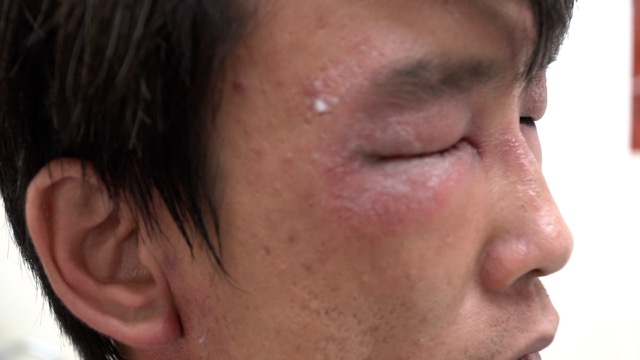 Kien Ba Huong absolutely did not arbitrarily buy medicine to treat the attack, and needed to see a doctor for examination. Photo: Nguyen Ly