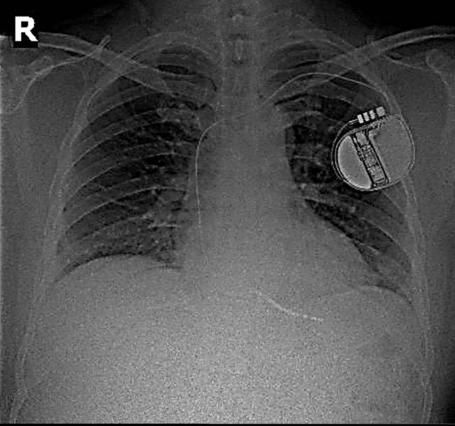 Image of the patient's heart-breaking device on X-ray film. Photo: BVCC