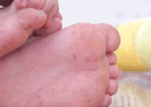 Doctor warns of severe hand, foot and mouth disease in young people, how to distinguish blisters