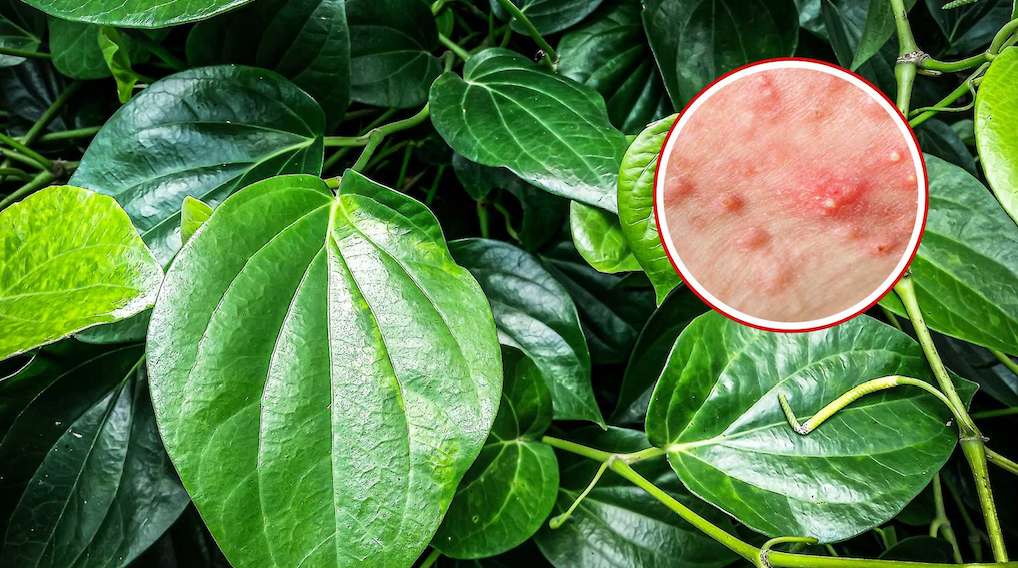 A folk secret to effectively reducing acne. Graphics: Viet Hoang