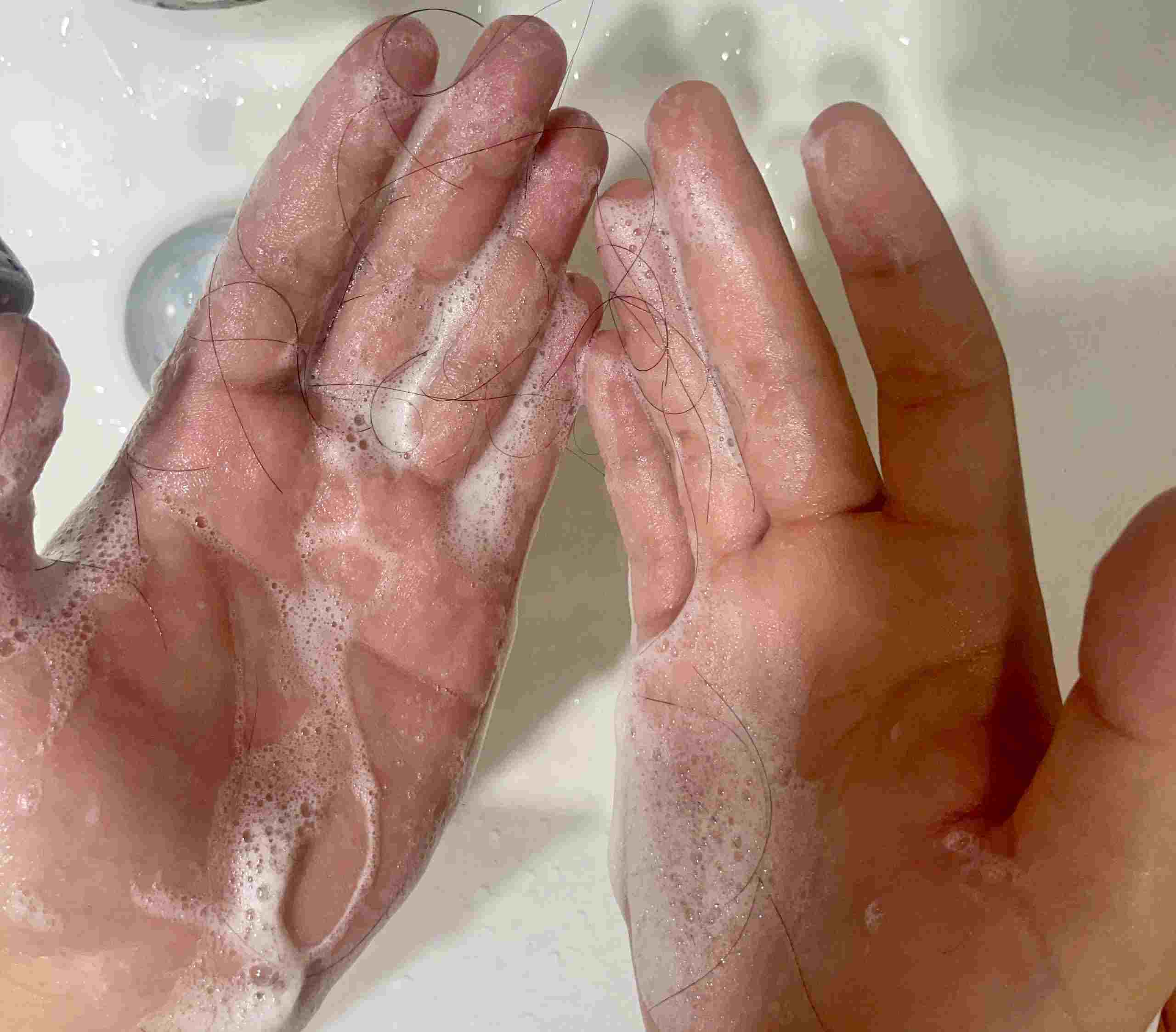 Toc rung nhieu khi goi dau la mot trong nhung dau hieu. Anh: Minh Vu 