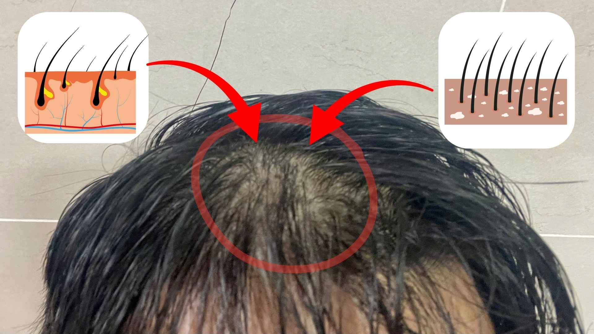 Nguyen nhan va cach xu ly tinh trang rung toc tung vung. Anh va do hoa: Minh Vu