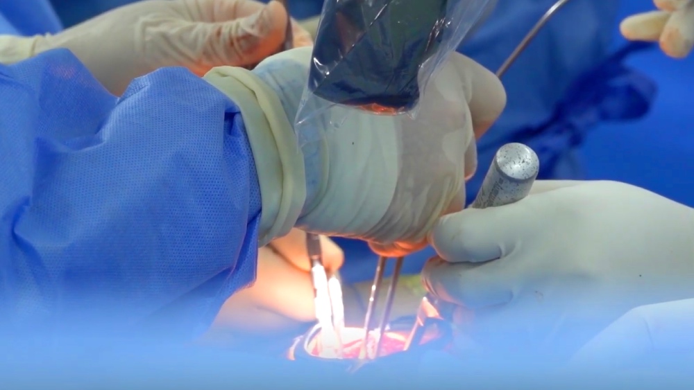 E-kip bac si Benh vien DKTW Can Tho phau thuat cot song cho benh nhan DBSCL. Anh: DVCC.