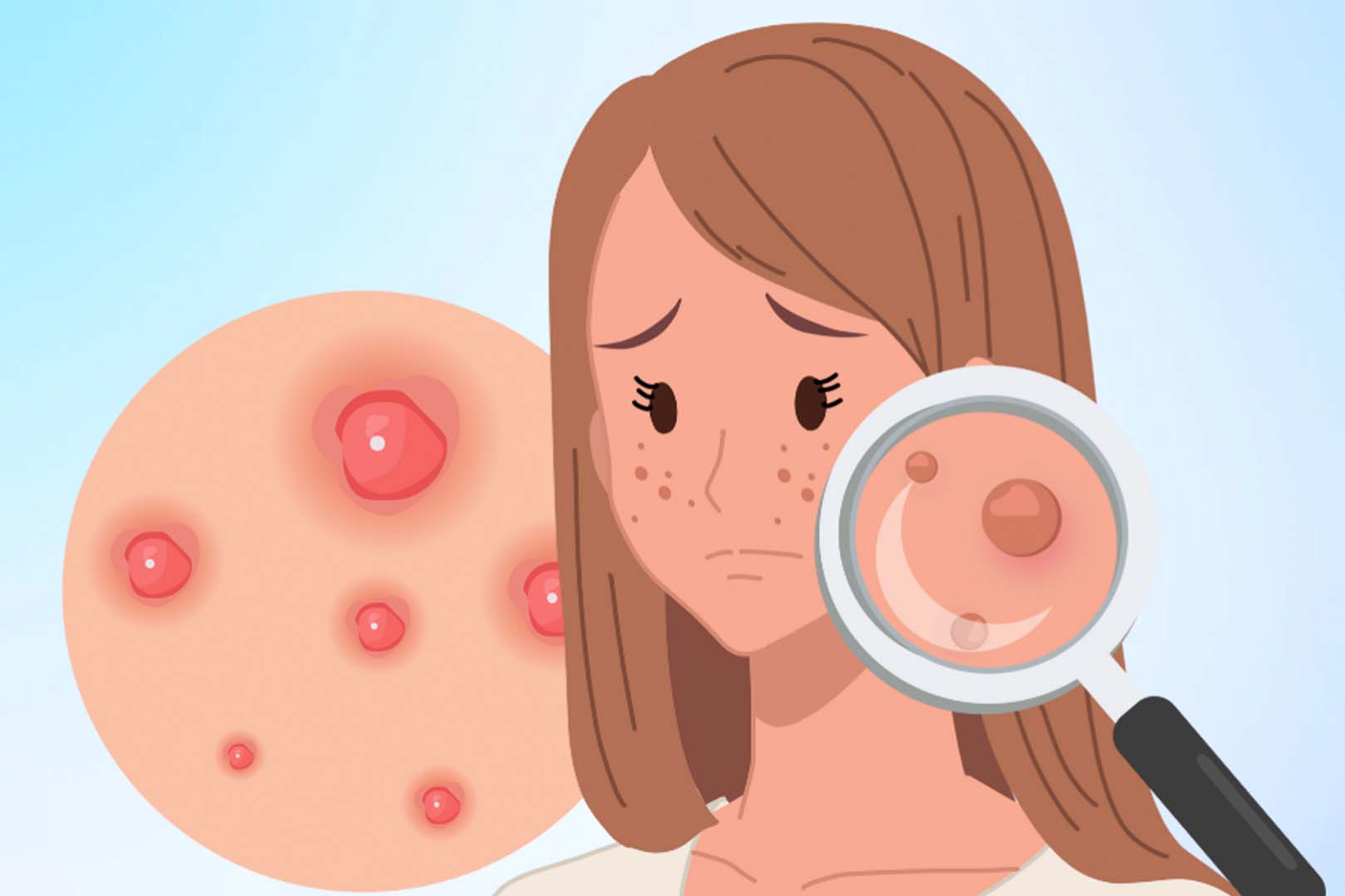 Causes of persistent acne and effective control. Graphics: Thien Nhan