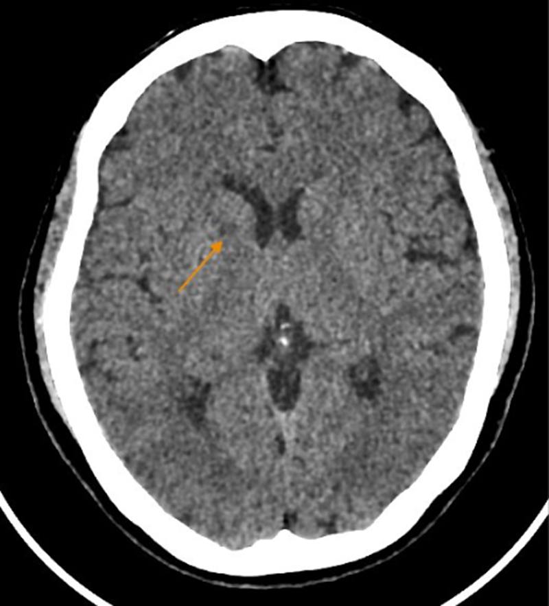 The old woman suffered a stroke while going to the toilet at 2am. A computer-based cranial scan showed signs of abnormality. Photo: BVCC