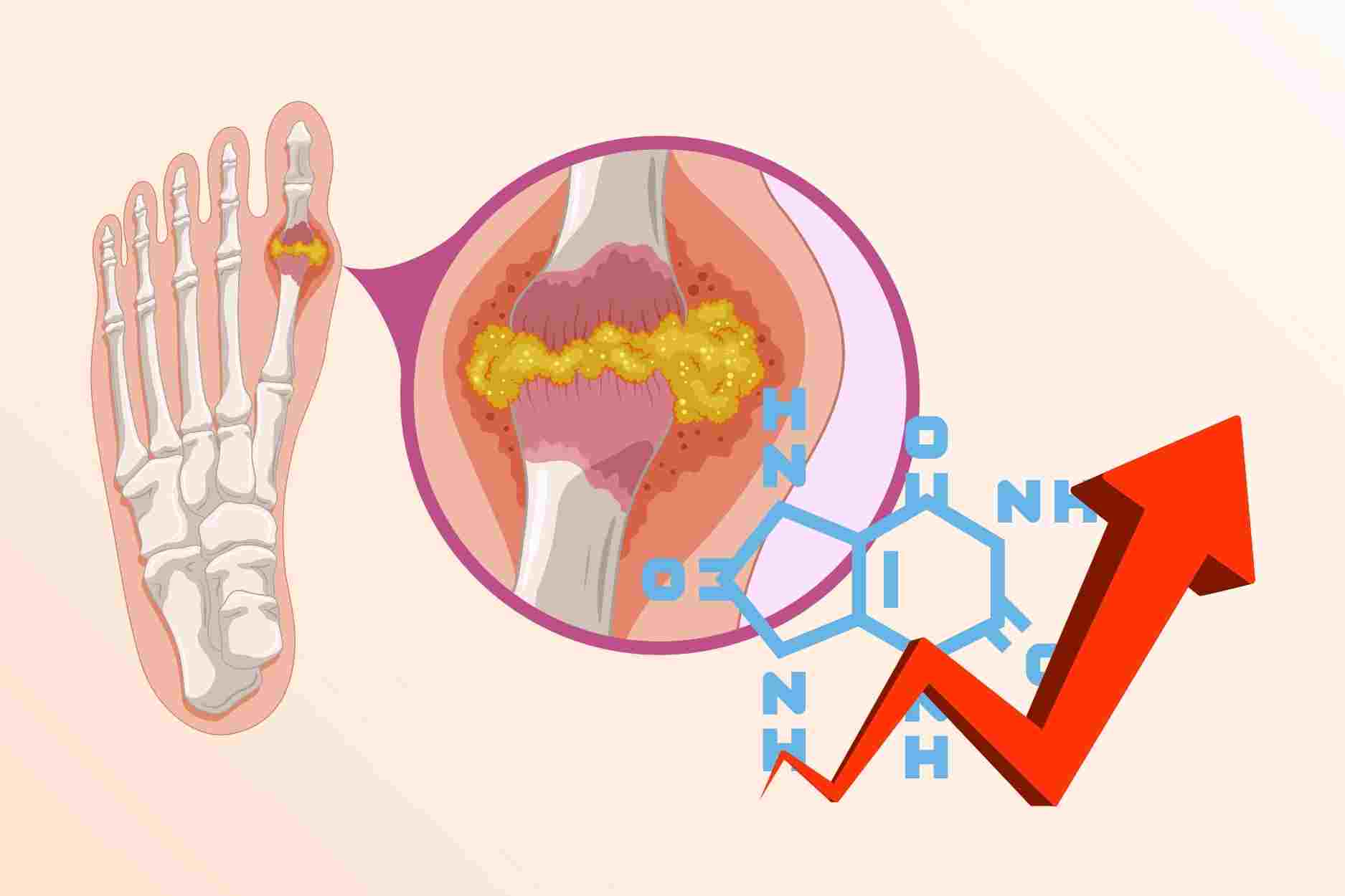 The skin and soft tissue around joints also reflect high uric acid. Photo: Cao Thom